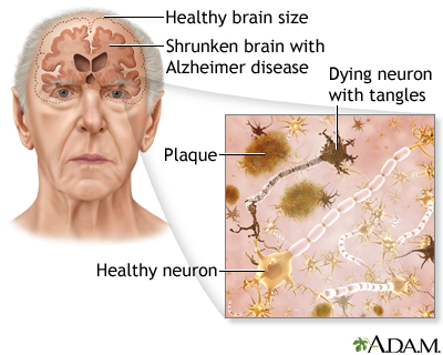 Picture of healthy v shrunken brain